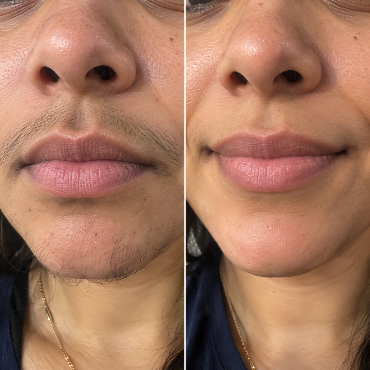 ENZARA Facial Hair Remover